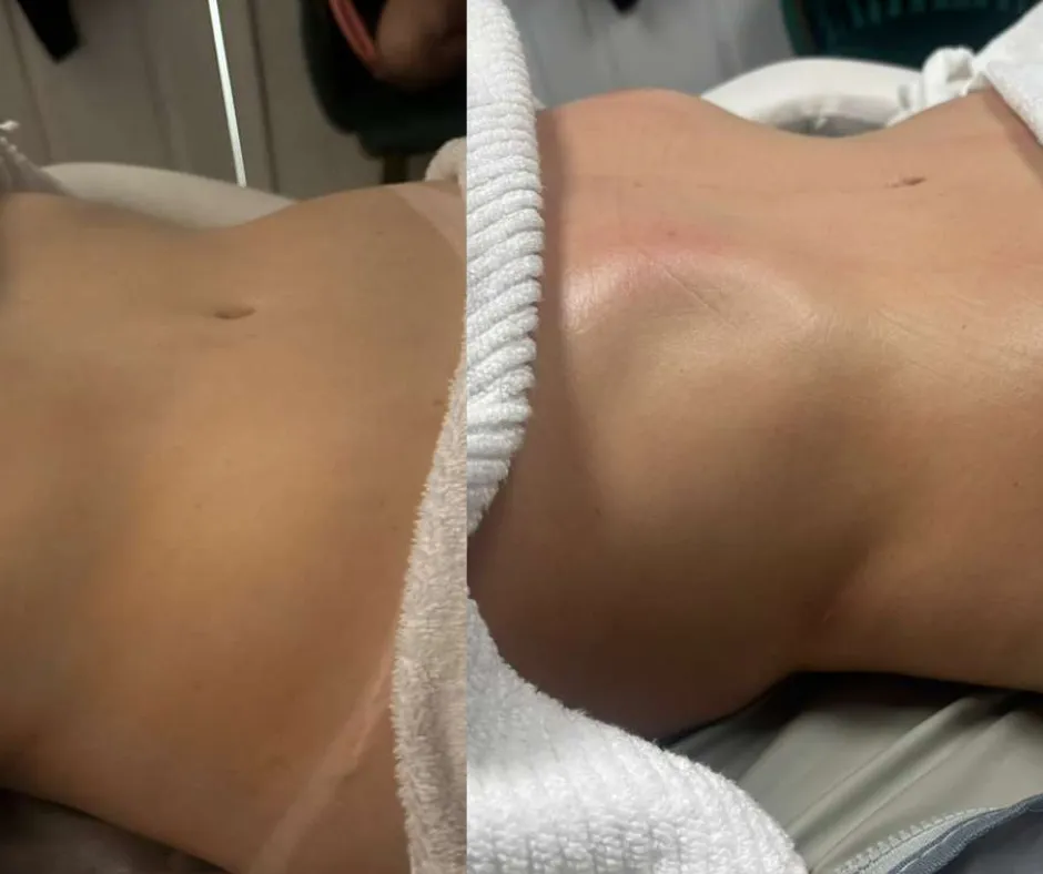 Before and After - Drenagem Linfática Método Renata França