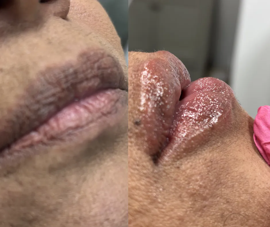 Before and After - Hydrolips: Hydrated Lips